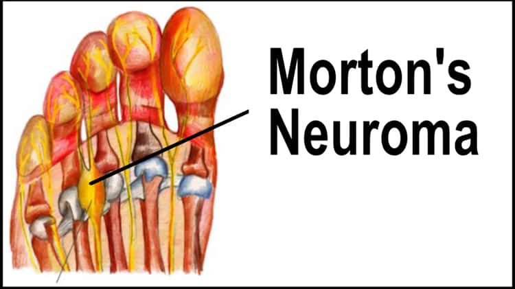 Morton s Neuroma Treatment Temple Hill Clinton MD Dr. Burton Katzen