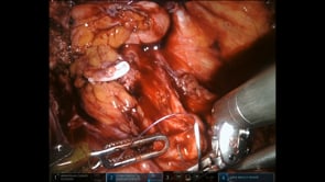 REPARACION URETEROVESICAL CON FLAP DE BOARI ASISTIDO POR ROBOT:  DESCRIPCION DE LA TECNICA PASO A PASO