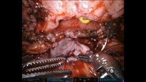 REPARACION DE FISTULA VESICOVAGINAL UTILIZANDO FLAP PERITONEAL ASISTIDA POR ROBOT: DESCRIPCION DE LA TECNICA PASO A PASO