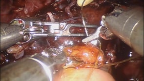 NEOVEJIGA ORTOTOPICA ROBOTICA TIPO HAUTMANN TOTALMENTE INTRACORPOREA