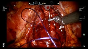 PROSTATECTOMÍA RADICAL LAPAROSCÓPICA ASISTIDA POR ROBOT CON PRESERVACIÓN DE LA FASCIA ENDOPÉLVICA Y COMPLEJO VENOSO DORSAL.