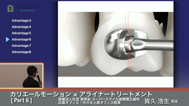 矯正歯科のトレンド ～カリエールモーション×アライナートリートメント～ #6