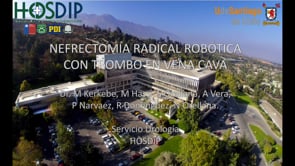 NEFRECTOMIA RADICAL ROBÓTICA CON TROMBO EN VENA CAVA