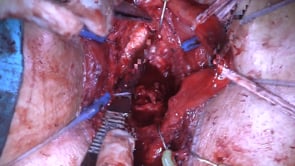 RECONSTRUCCION DE ANASTOMOSIS OBLITERADA POST PROSTATECTOMIA RADICAL, MEDIANTE URETROPLASTÍA TERMINO-TERMINAL BULBO-VESICAL POR VIA PERINEAL