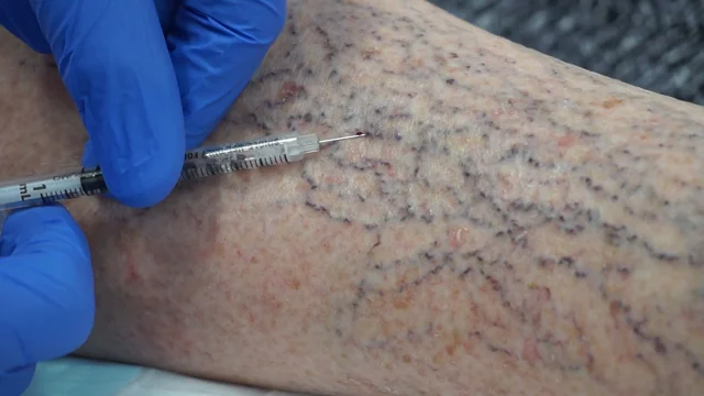 Injection sclerotherapy – The Vein Lab