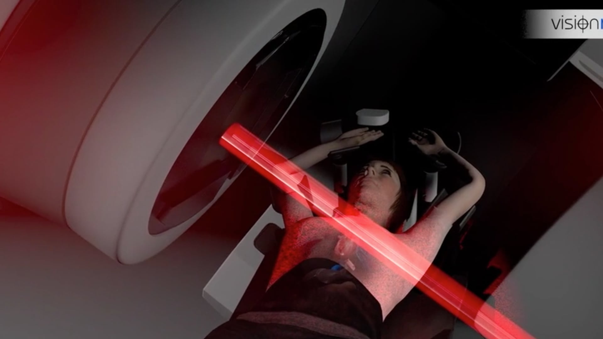 ALIGNRT FOR LEFT-BREASTED RADIOTHERAPY PATIENTS