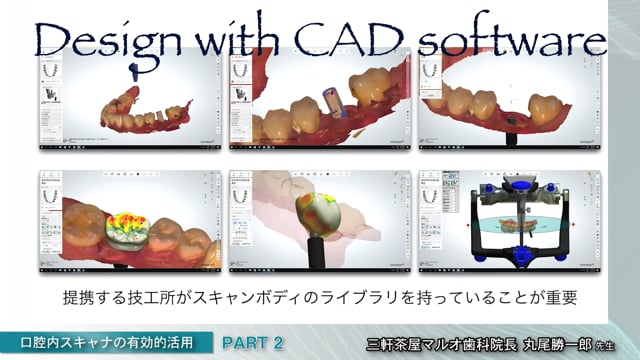 #2 インプラントの光学印象