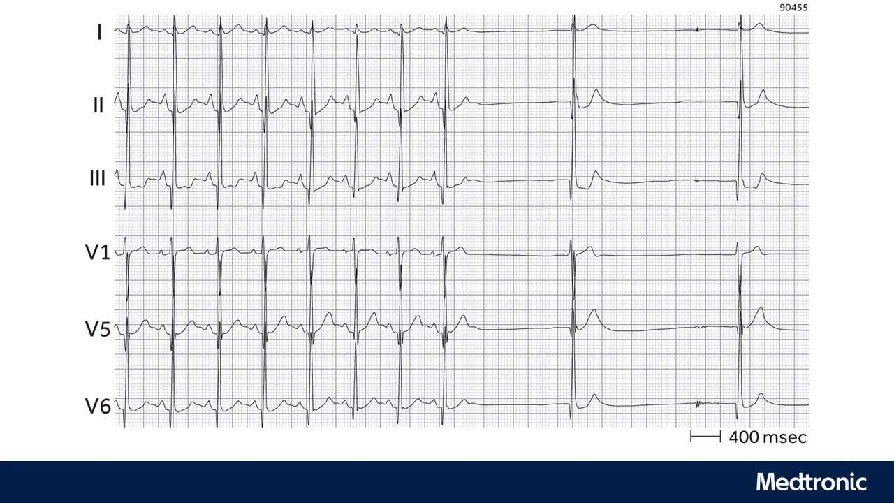 Friday Lecture - Medtronic Friday PART 1_SC 16-18 Sick SS ECG FIND on Vimeo