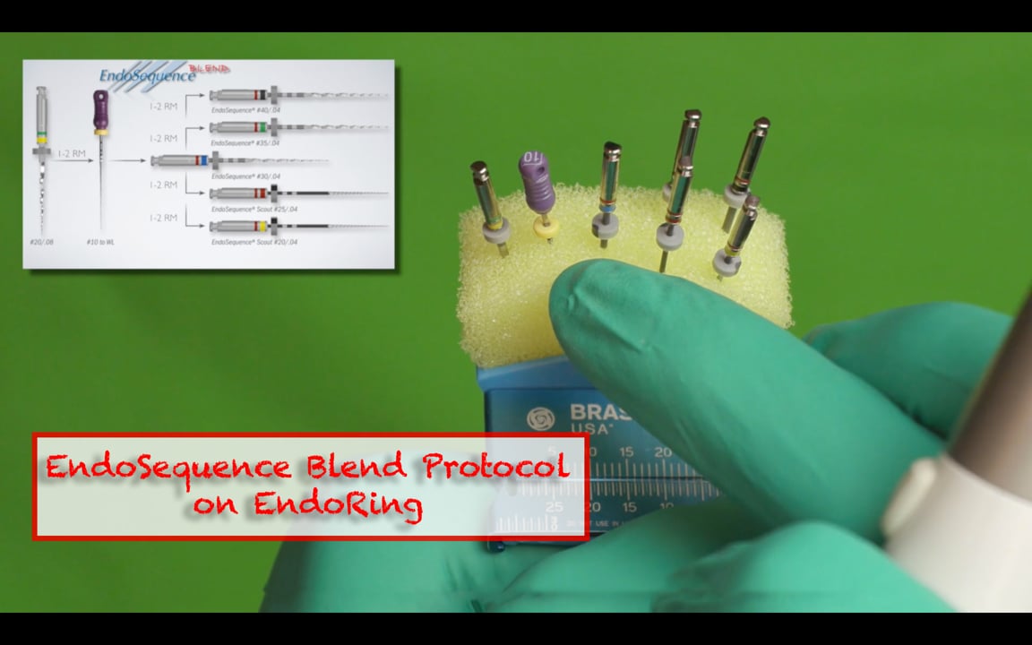 EndoSequence Blend Protocol on Endo Ring Real World Endo