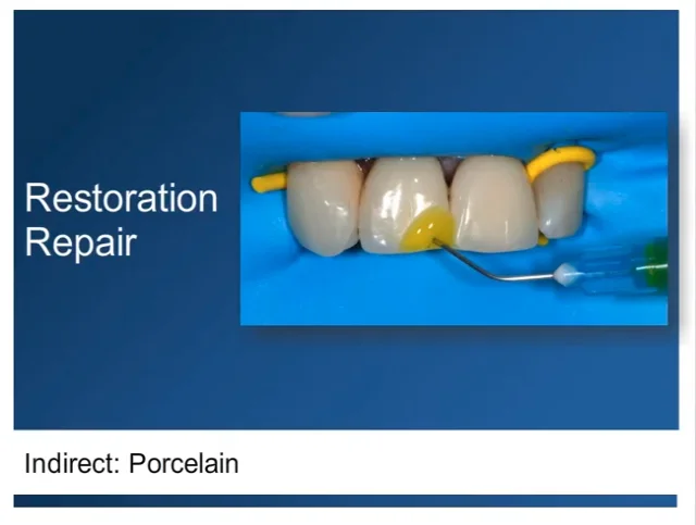 Dental Porcelain Repair - Porcelain Repair PFM Kit