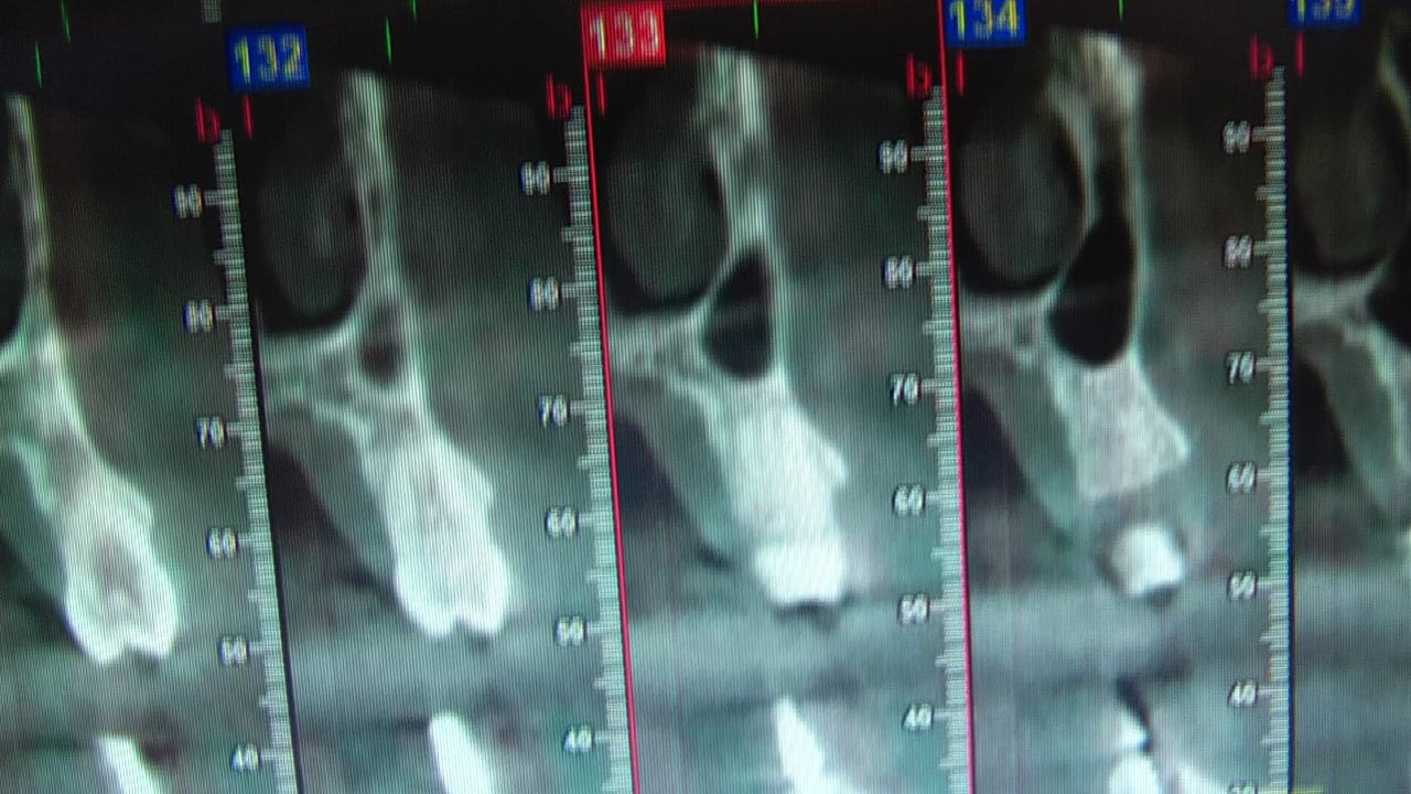 MONOIMPLANT.CLINICA DOCTORES REY.