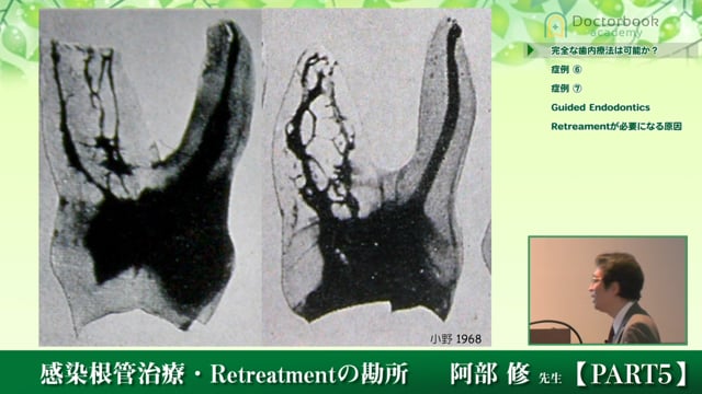 #5 完全な歯内療法は可能か