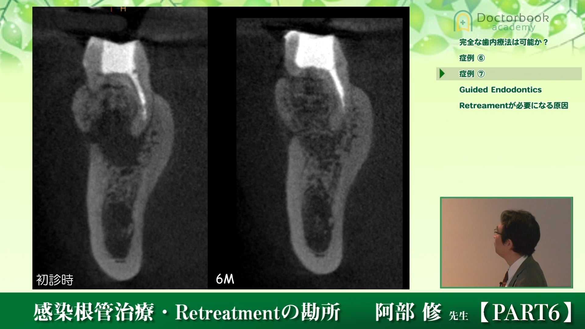 #6 根尖病変の治癒形態