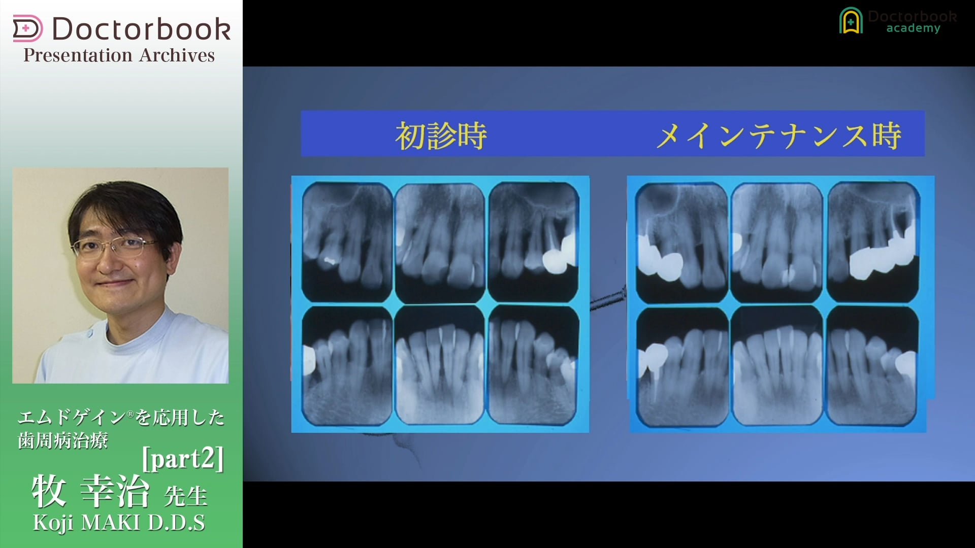 エムドゲイン®を応用した歯周病治療 #2