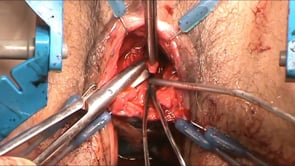 URETROPLASTÍA FEMENINA MEDIANTE INJERTO DORSAL DE MUCOSA ORAL: PRINCIPIOS ANATÓMICOS Y CONTINENCIA