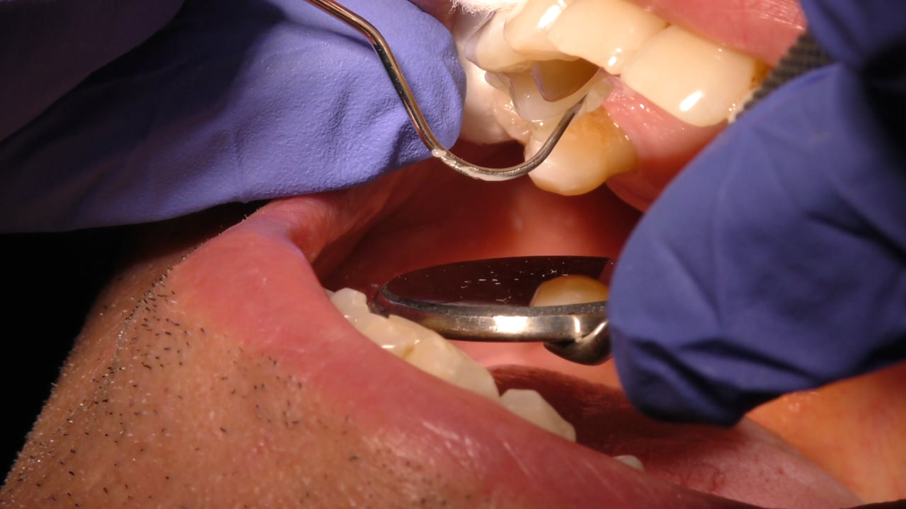 Implantes Midi technique doctores Rey