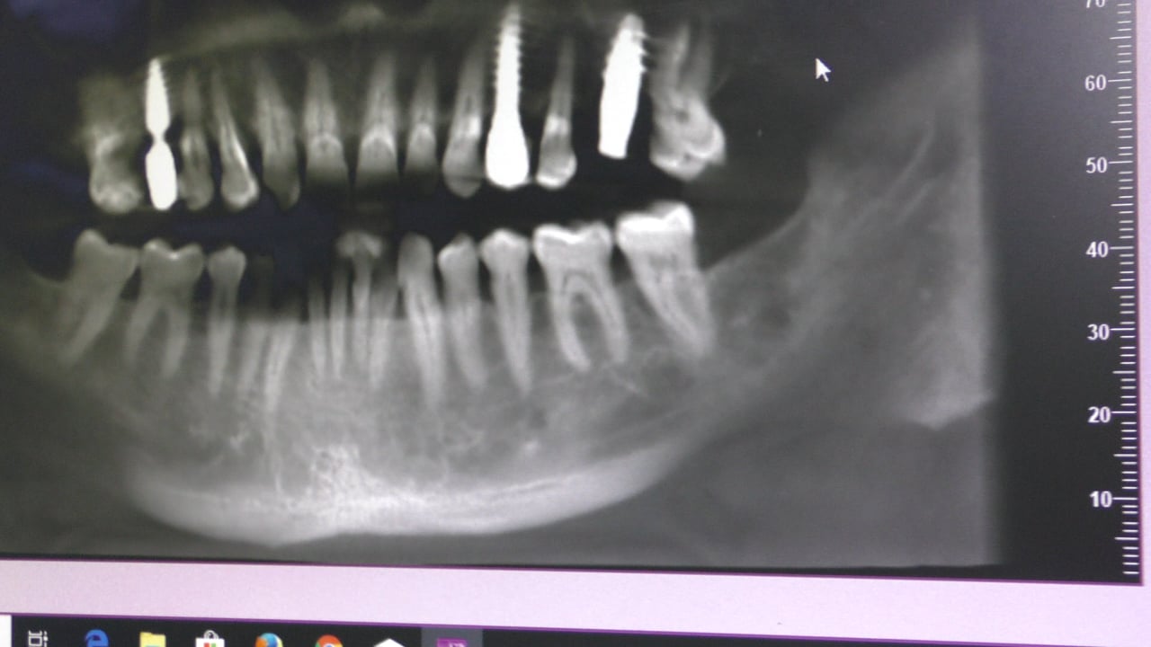 Implantes Midi technique doctores Rey