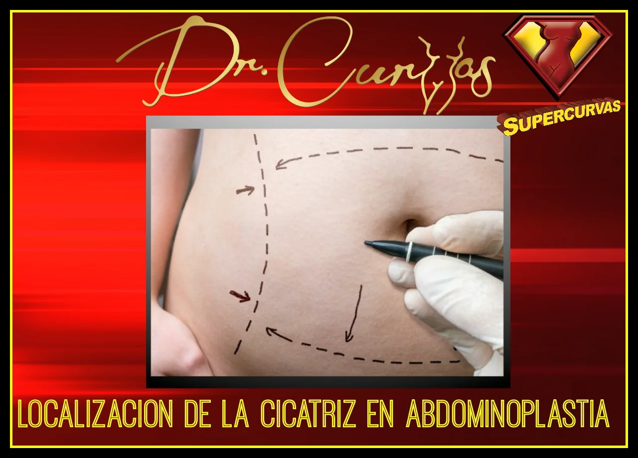 necesito una abdominoplastia? on Vimeo