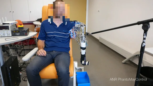 A prosthetic arm that decodes phantom limb mo