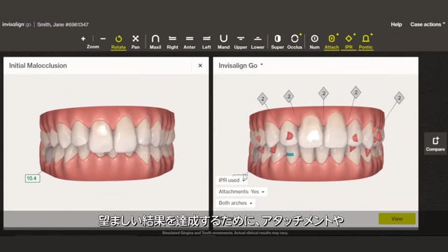 【PV】前歯部を気軽に、美しく。インビザライン Goシステム治療のメリット紹介