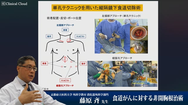 藤原 斉先生：食道がんに対する非開胸根治術