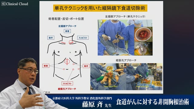 食道がんに対する非開胸根治術