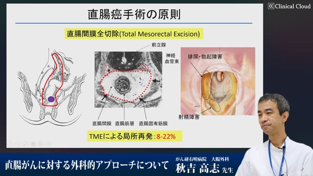 直腸がんに対する外科的アプローチについて | Clinical Cloud