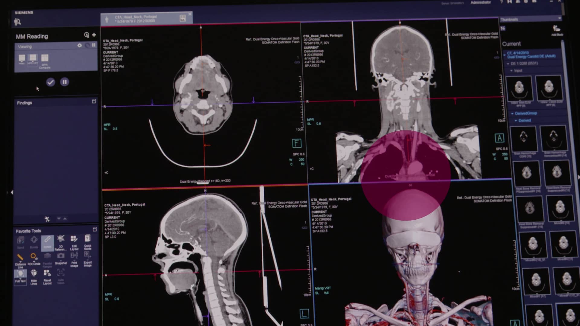 syngo.via - Siemens Healthcare GmbH on Vimeo
