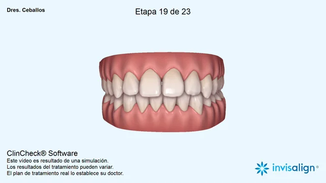 Ortodoncia invisible en Málaga - Clínica Ceballos