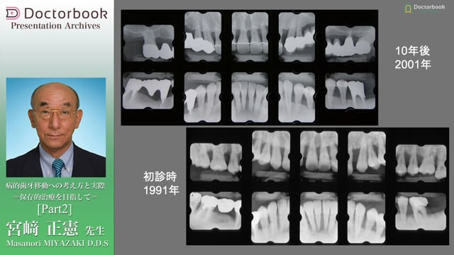 病的歯牙移動（PTM）への考え方と実際 〜保存的治療を目指して 