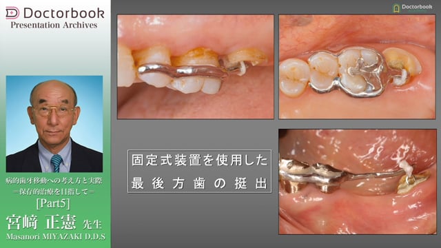 病的歯牙移動（PTM）への考え方と実際 〜保存的治療を目指して 