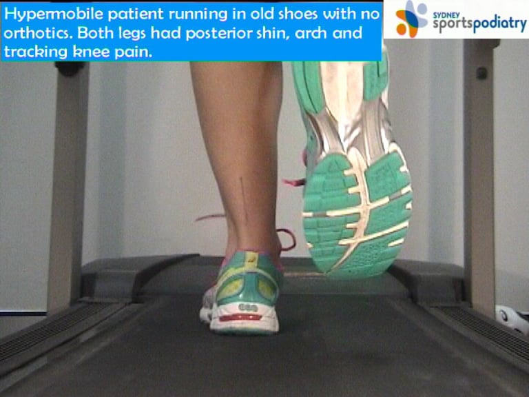 Hypermobility and 'Second Ankle Syndrome' on Vimeo