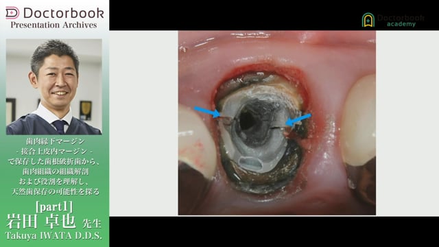 歯肉縁下マージン ー接合上皮内マージンー で保存した歯根破折歯ケースから、歯肉組織の組織解剖および役割を理解し、天然歯保存の可能性を探る