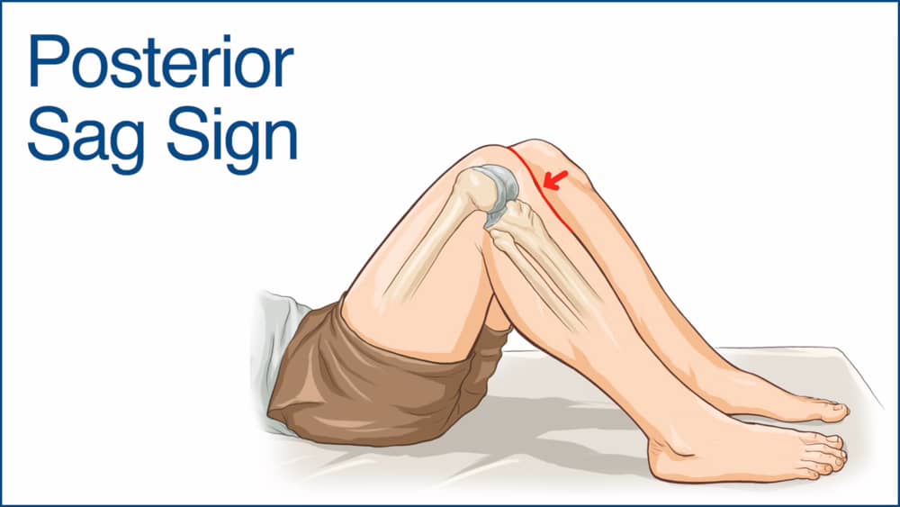 Video Posterior Sag Sign Chiropractic Online Ce Com