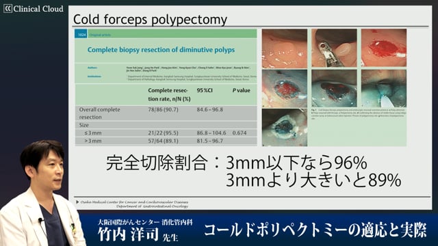 コールドポリペクトミーの適応と実際
