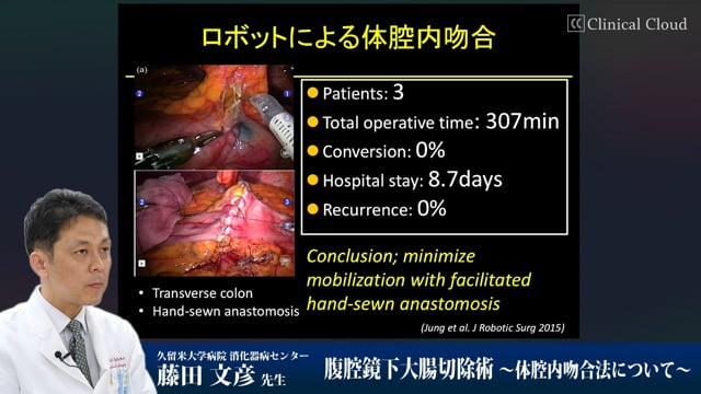 腹腔鏡下大腸切除術～体腔内吻合法について～