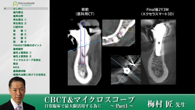 CBCT&マイクロスコープ 日常臨床で最大限活用する為に【ご好評につきプレミアムコンテンツ化】