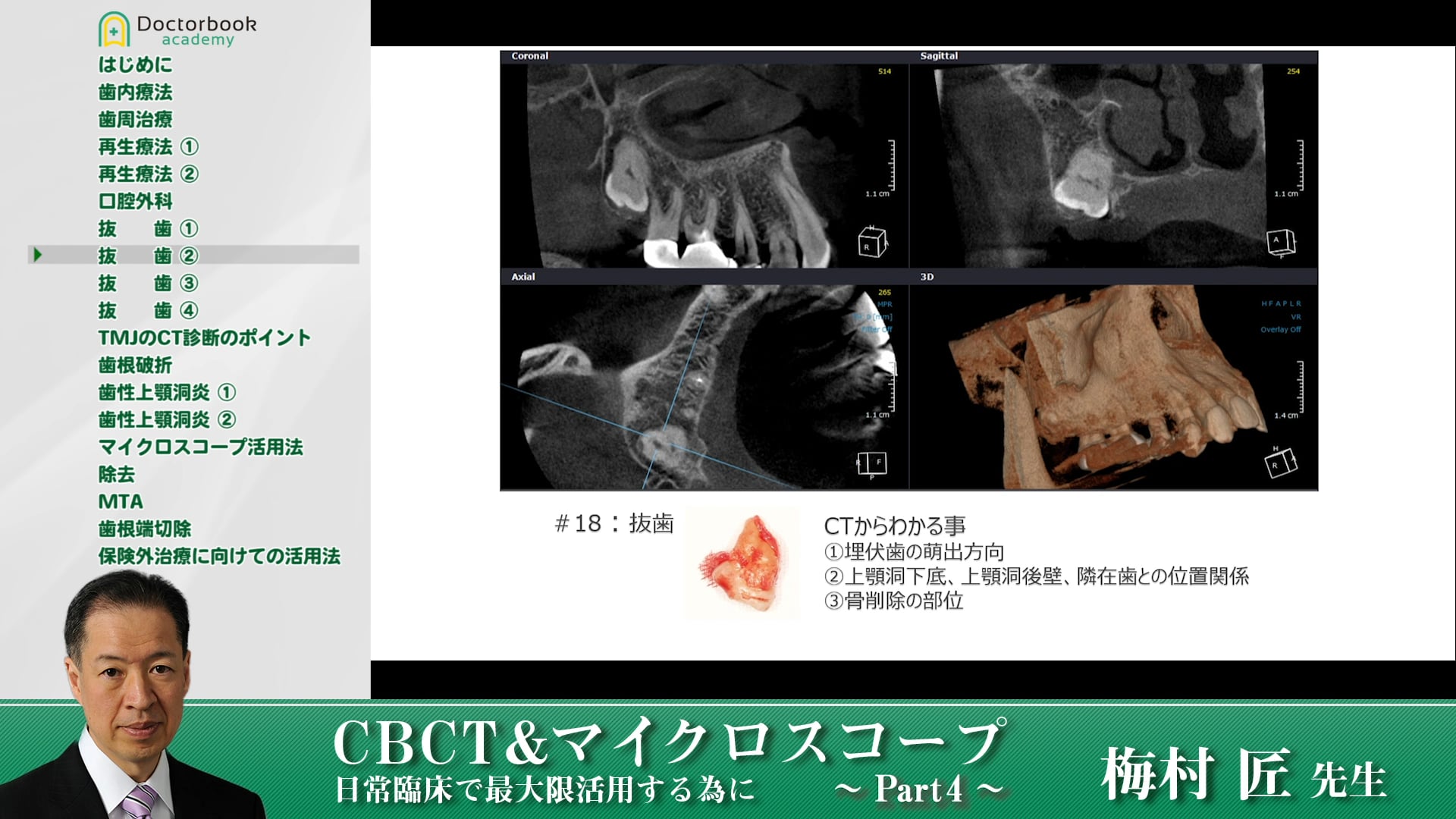 口腔外科でのCTの有用性 #4