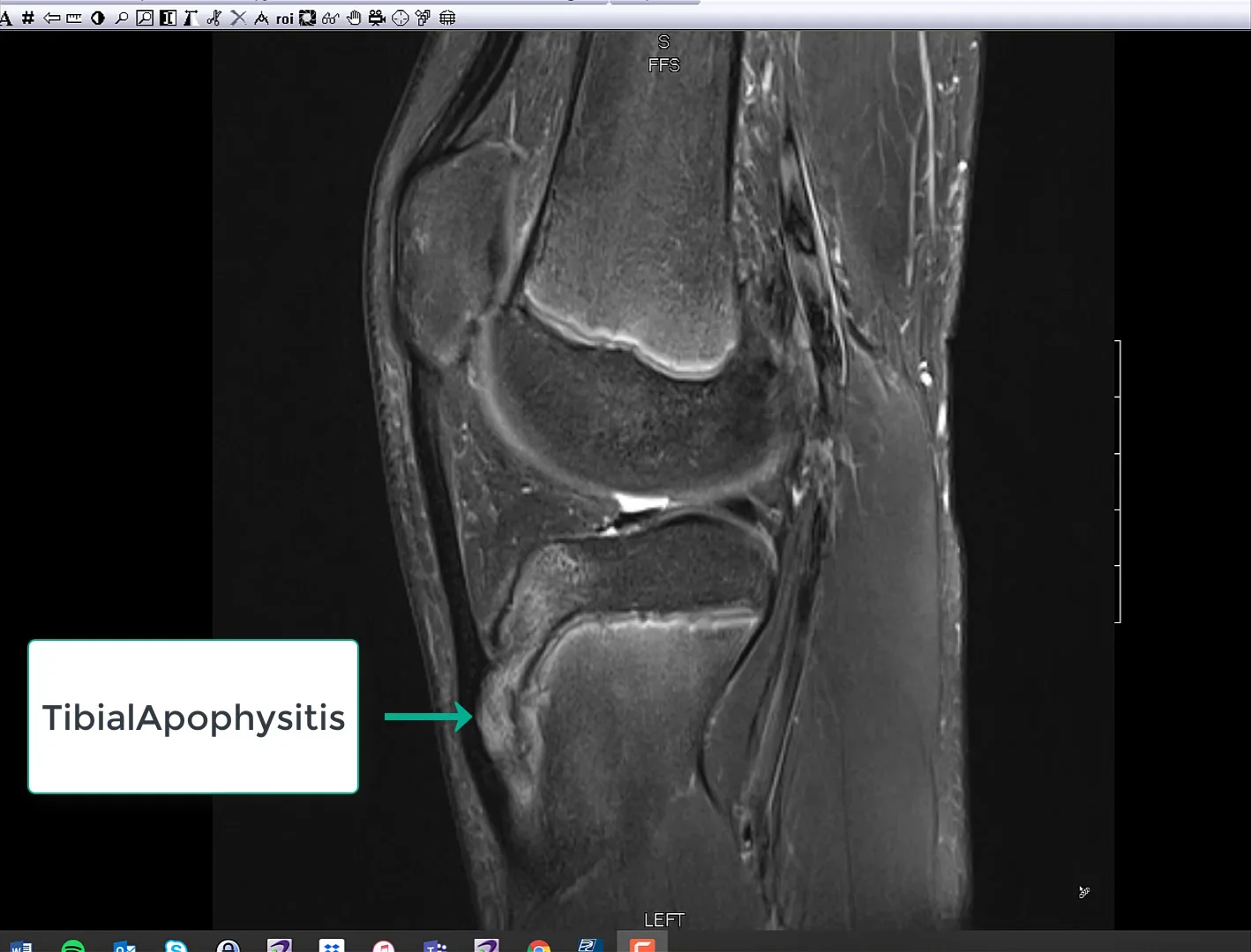 Tibial Apophysitis on Vimeo