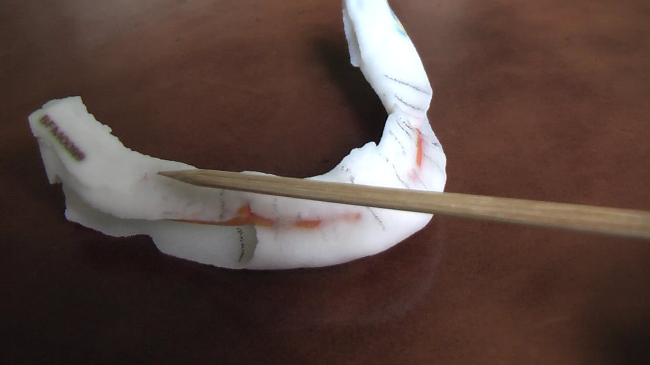 Reabsorción mandibular extrema