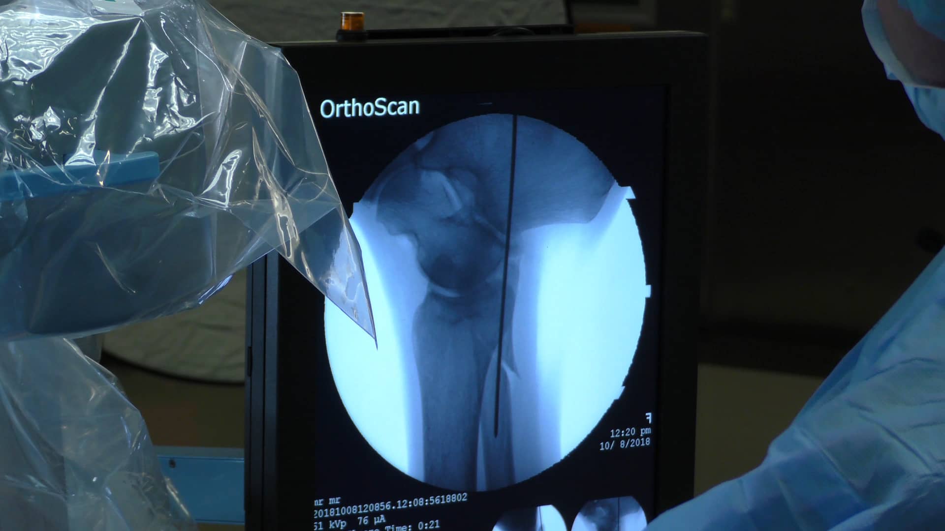 Weber B Fracture Fixation Using the Fibula Rod with Alastair Younger ...
