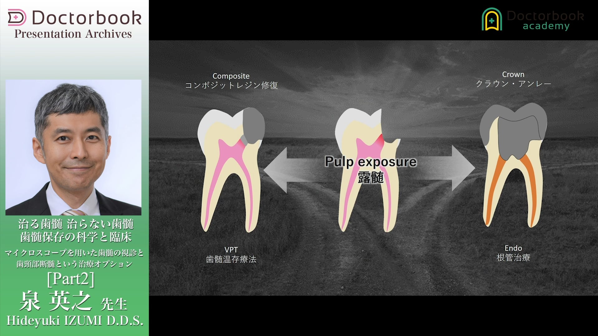 #2 歯髄温存の診断基準