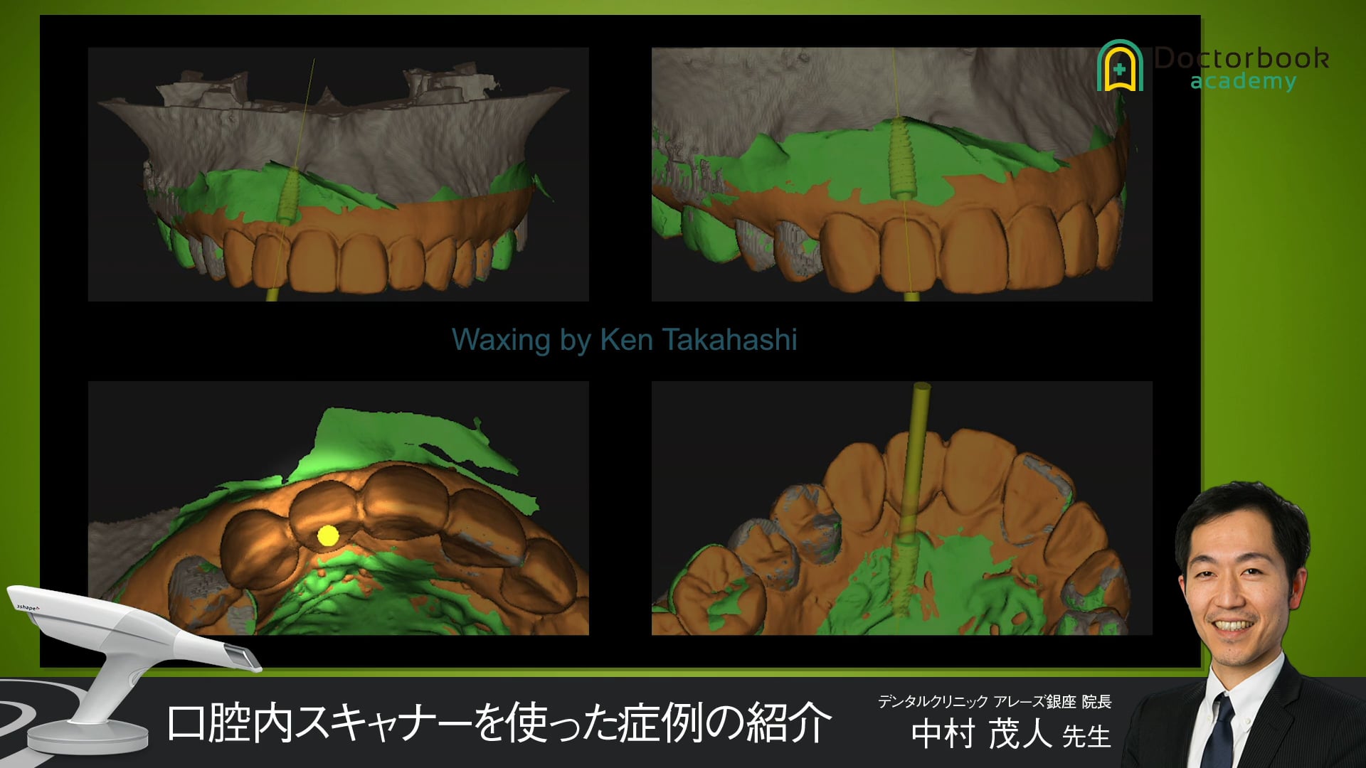 口腔内スキャナーを使った症例の紹介