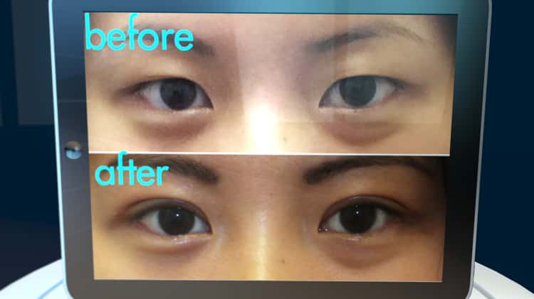 Suture double eyelid sale surgery