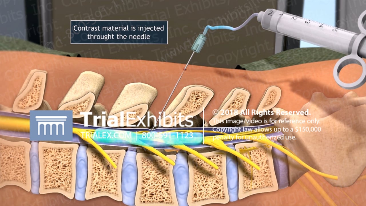 Myelogram Procedure | Videos & Movies on Vimeo