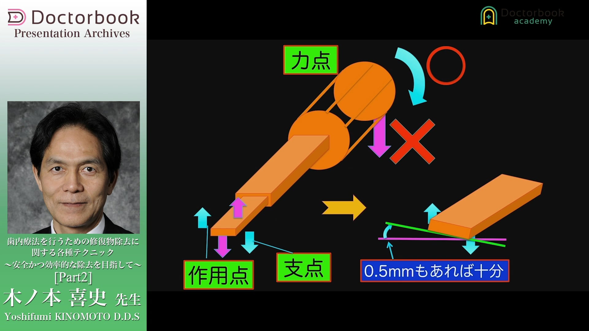 #2 WAM KeyとECRを用いたクラウンの除去