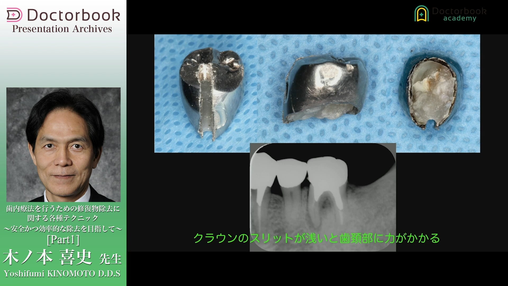 #1 クラウン除去に用いる器具