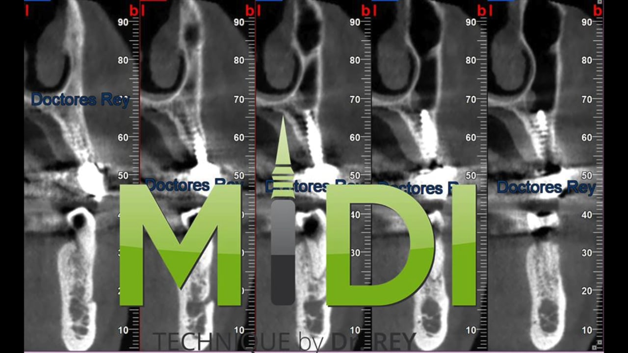ACADEMY MONOBLOCK IMPLANTS FUNTIONAL