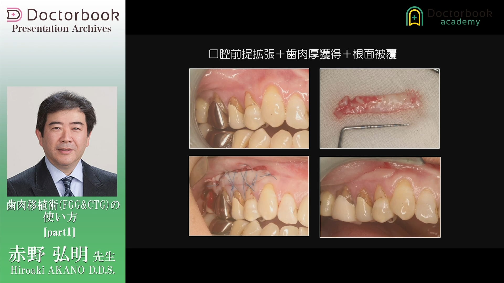 #1 Mucogingival problemとFGG