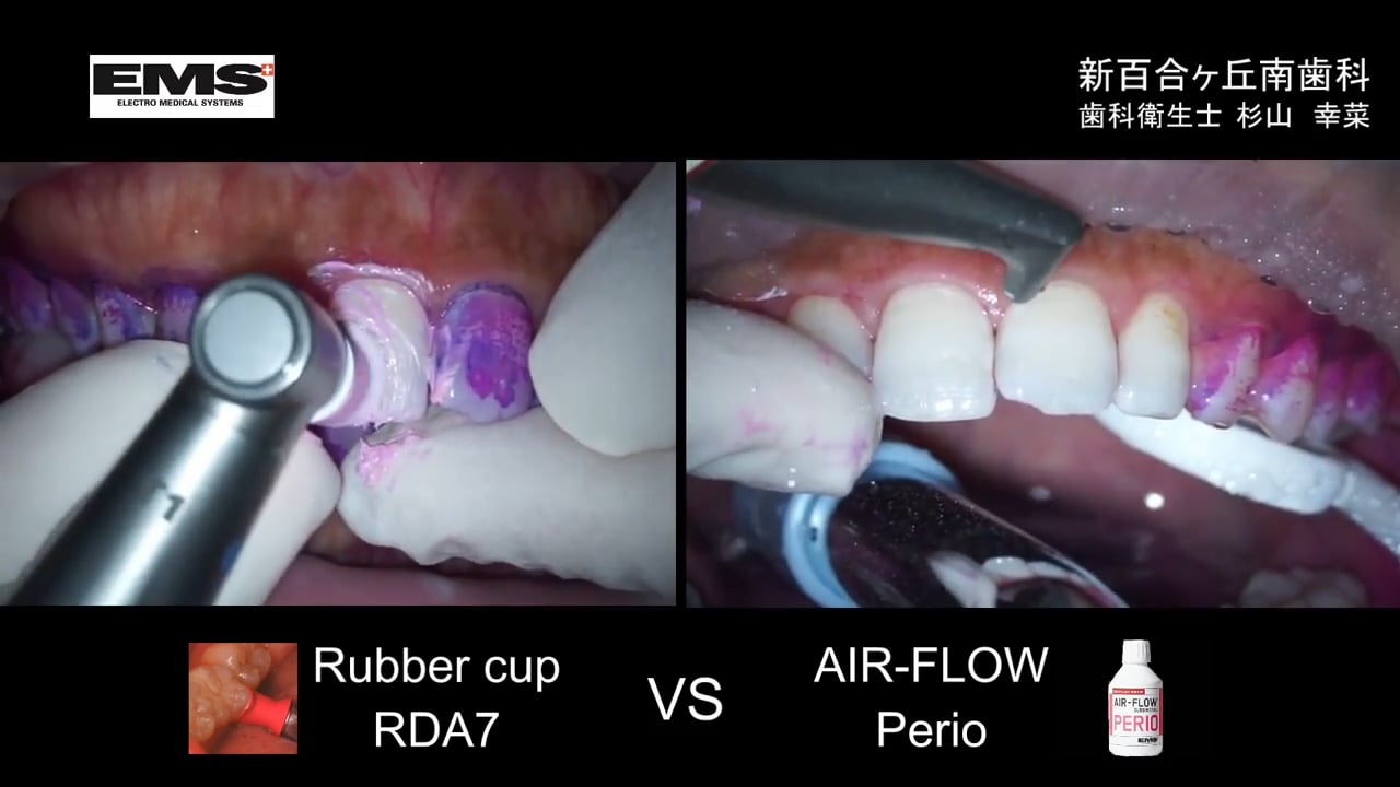 矯正ブラケット周囲エアフロー臨床動画① 新百合ヶ丘南歯科